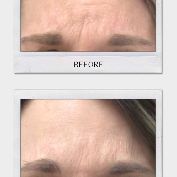 Botox Tulsa | You Can Be No Doubt That We Are Going To Get Things Done