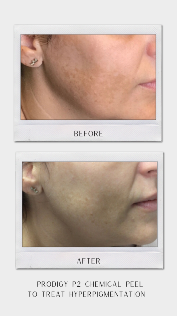 Tulsa Botox Hyperpigmentation BA Revitalize20210823 0002