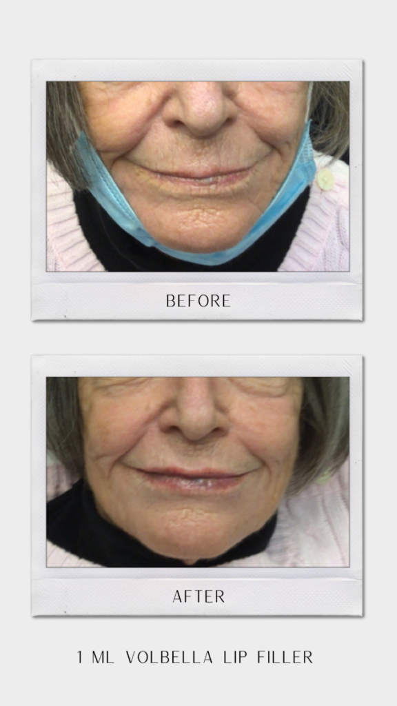 Tulsa Botox LipFiller BA Revitalize20210823 0002
