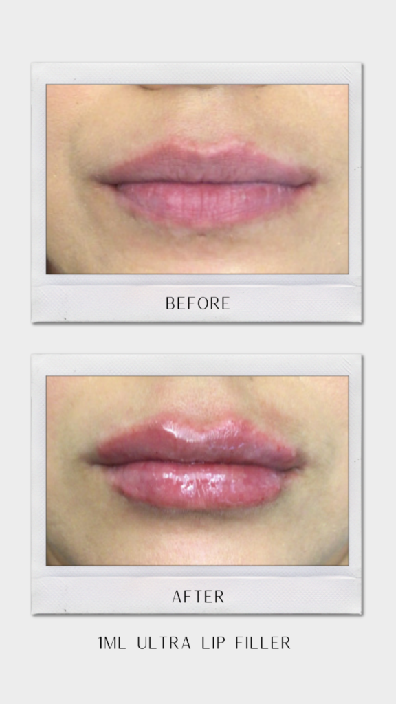 Tulsa Botox LipFiller BA Revitalize20210823 0003