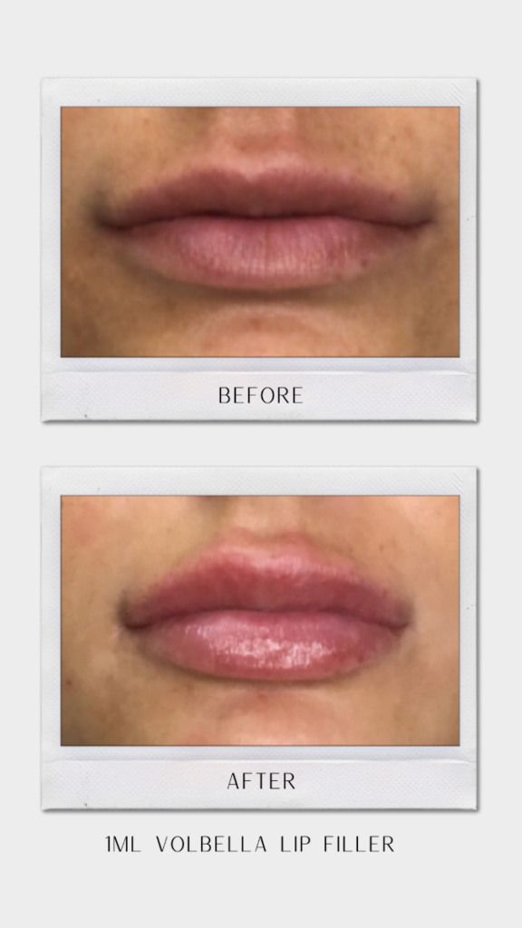 Tulsa Botox LipFiller BA Revitalize20210823 0005
