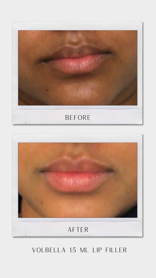 Tulsa Botox LipFiller BA Revitalize20210823 0006