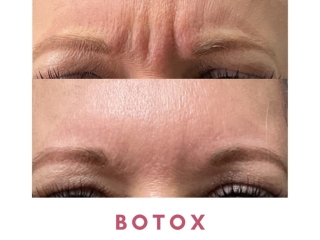 Jenks Botox Gallery Botox 1 Jenks Botox Gallery Botox 1