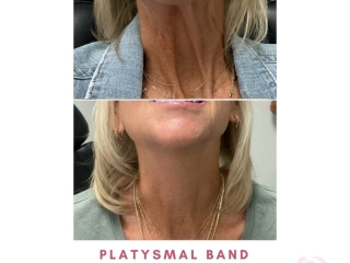 Jenks Botox Gallery Botox 2 Jenks Botox Gallery Botox 2