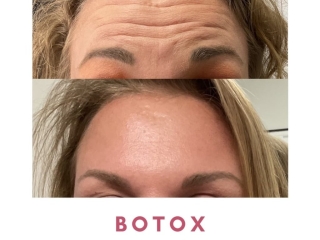 Jenks Botox Gallery Botox 3 Jenks Botox Gallery Botox 3