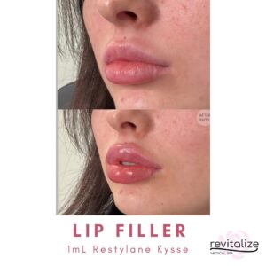 Revitalize Medical Spa Gallery Before After Lip Filler(1)