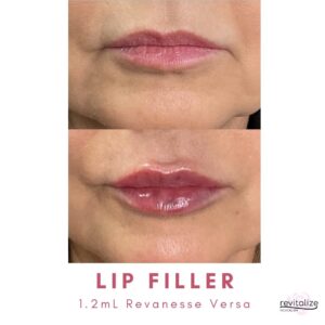 Revitalize Medical Spa Gallery Before After Lip Filler(2)