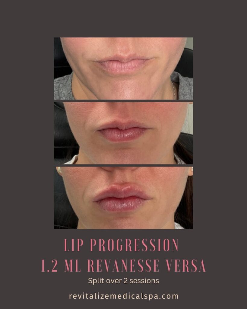 Revitalize Medical Spa Gallery Before After Lip Filler 2