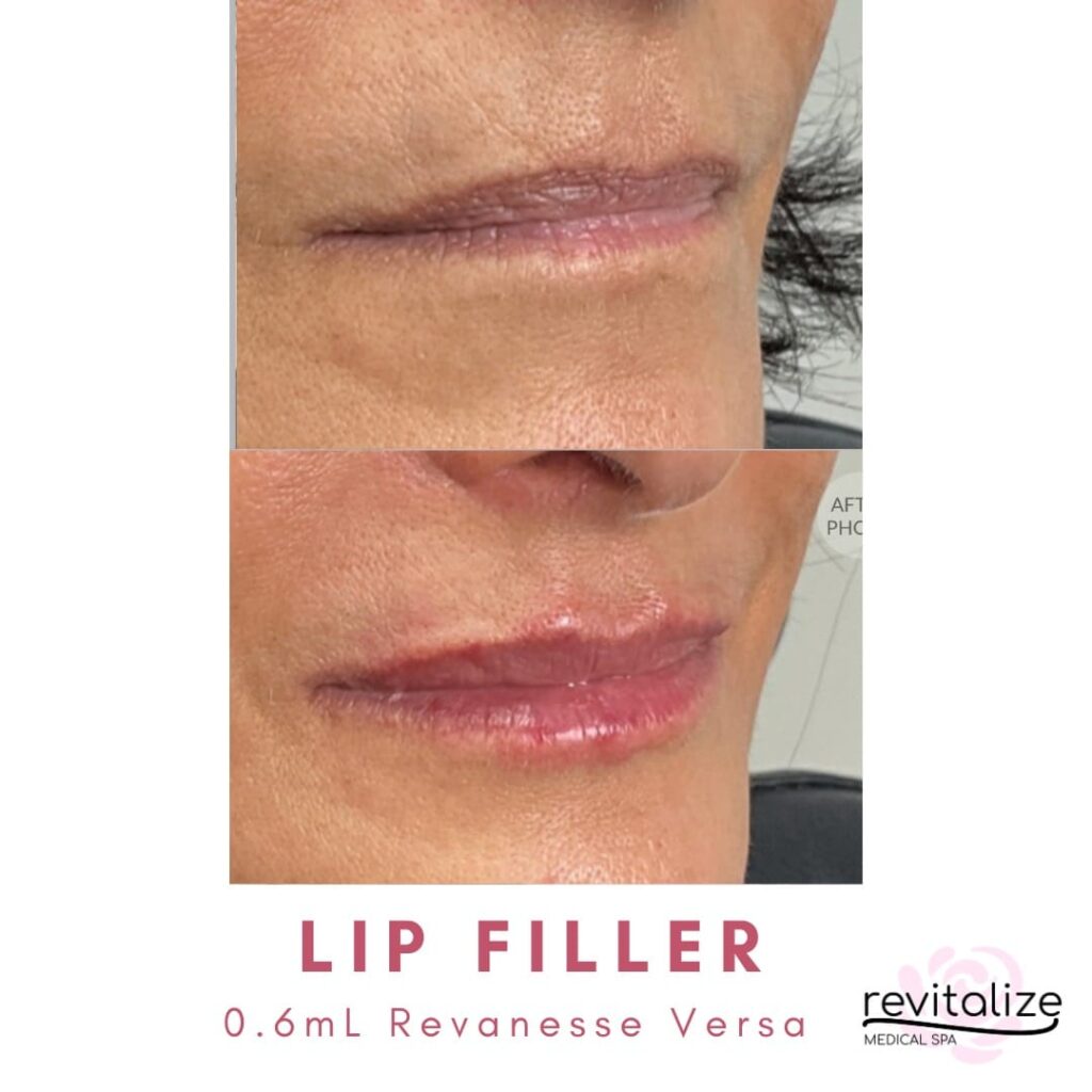 Revitalize Medical Spa Gallery Before After Lip Filler(10)