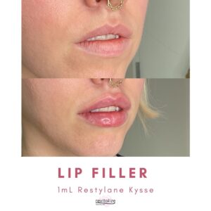 Revitalize Medical Spa Gallery Before After Lip Filler(11)