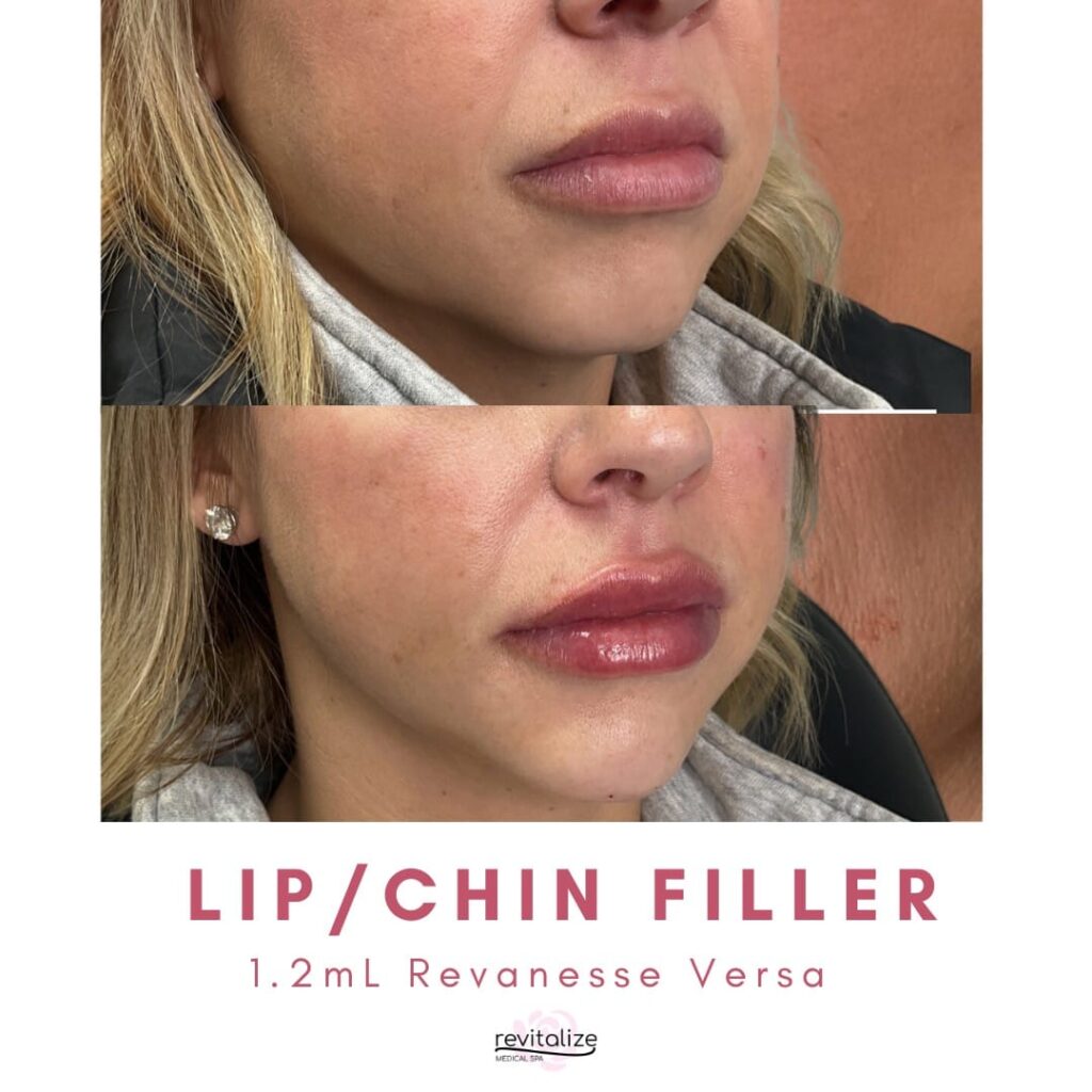 Revitalize Medical Spa Gallery Before After Lip Filler(13)