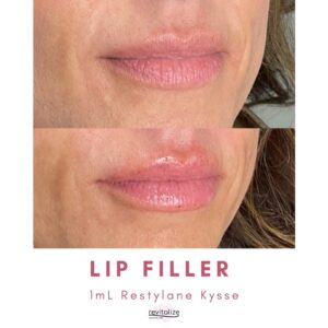 Revitalize Medical Spa Gallery Before After Lip Filler(15)