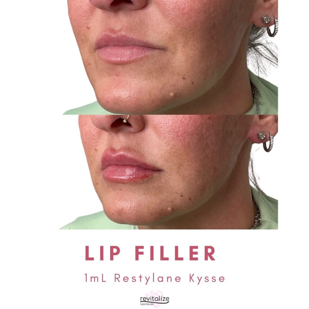 Revitalize Medical Spa Gallery Before After Lip Filler(16)