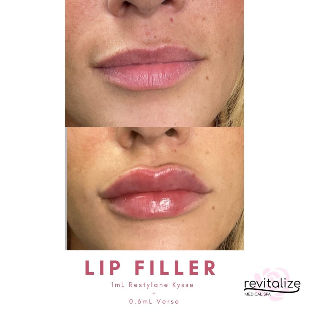 Revitalize Medical Spa Gallery Before After Lip Filler(4)