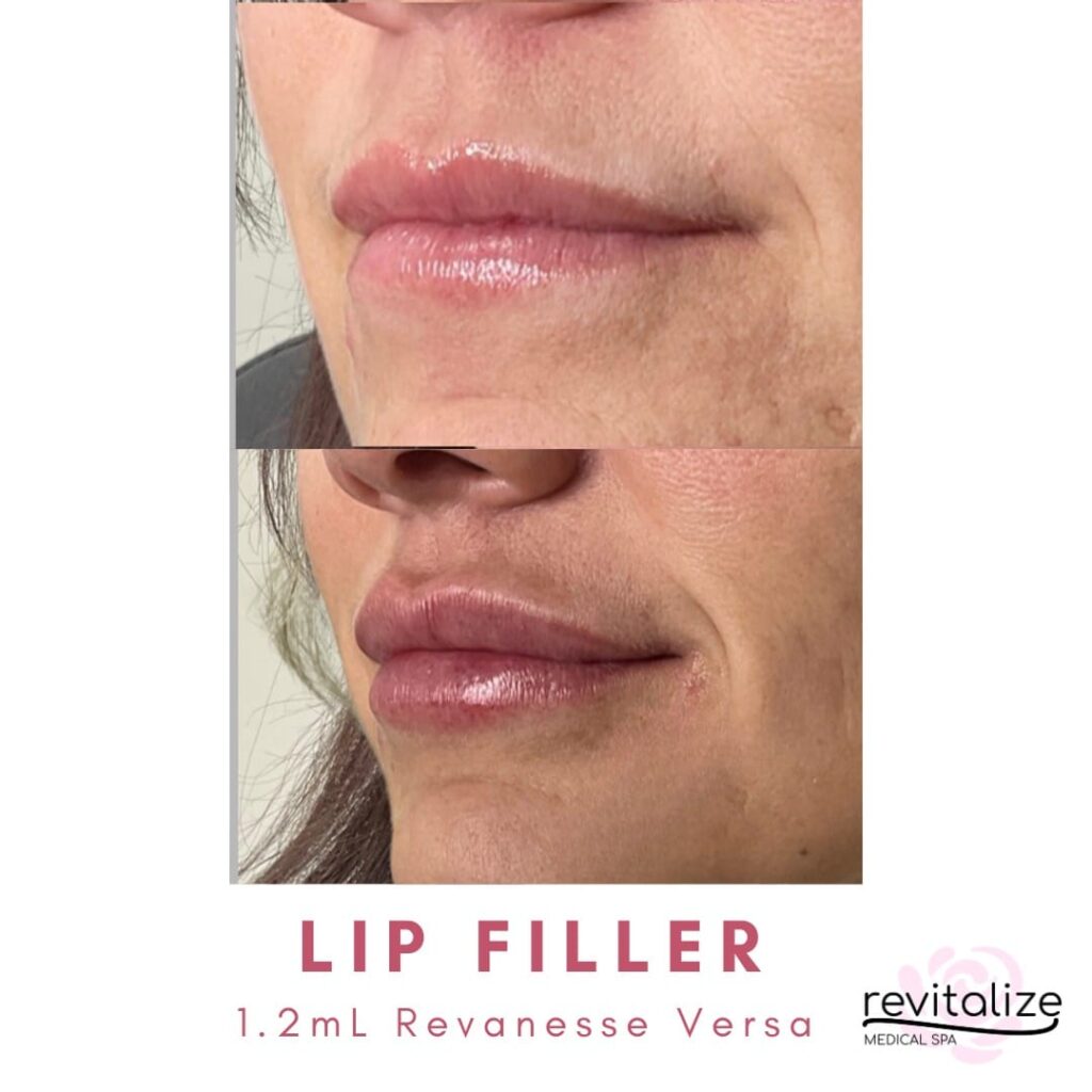 Revitalize Medical Spa Gallery Before After Lip Filler(6)