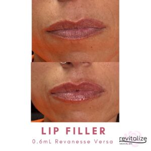 Revitalize Medical Spa Gallery Before After Lip Filler(7)