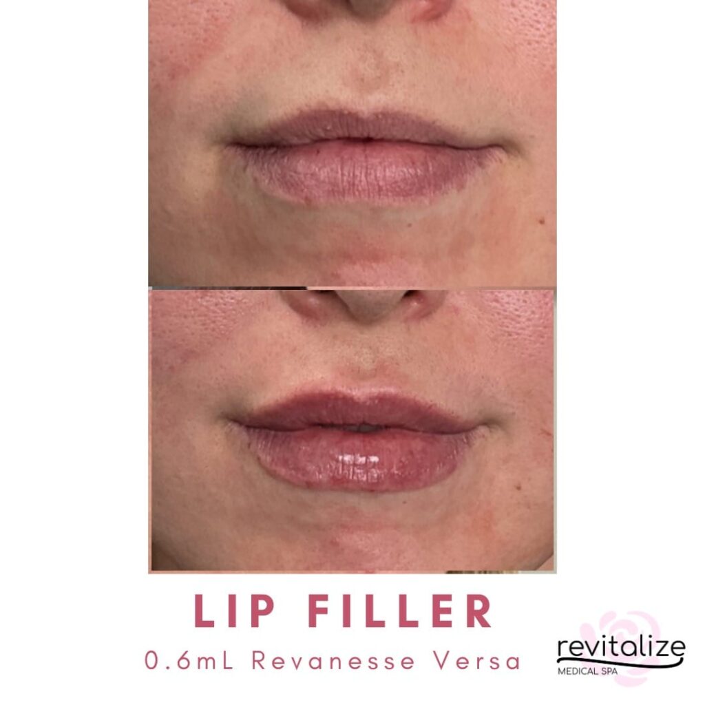 Revitalize Medical Spa Gallery Before After Lip Filler(9)