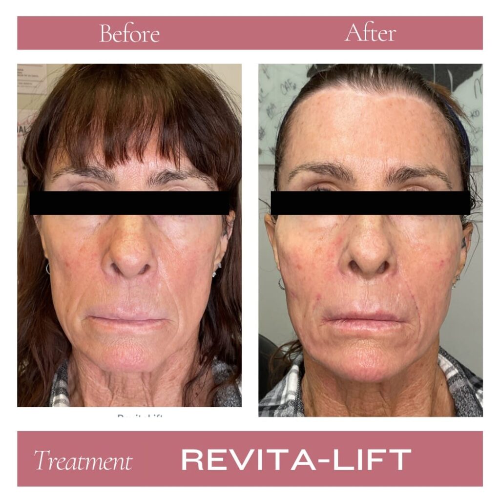 Revitalize Medical Spa Gallery Before After Revitalift Filler(1)