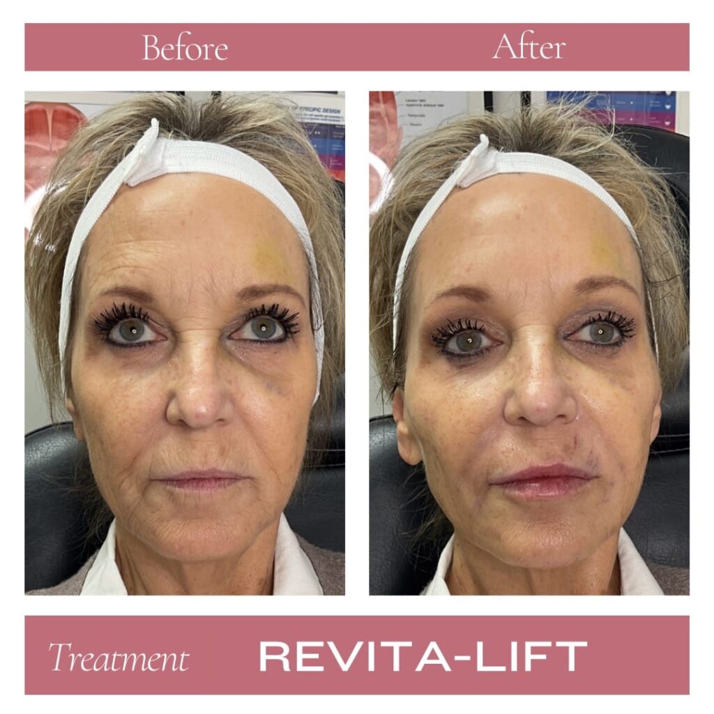 Revitalize Medical Spa Gallery Before After Revitalift Filler(2)