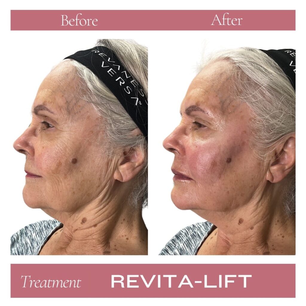 Revitalize Medical Spa Gallery Before After Revitalift Filler(5)