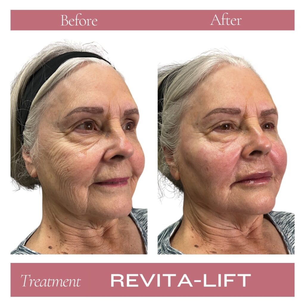 Revitalize Medical Spa Gallery Before After Revitalift Filler(6)