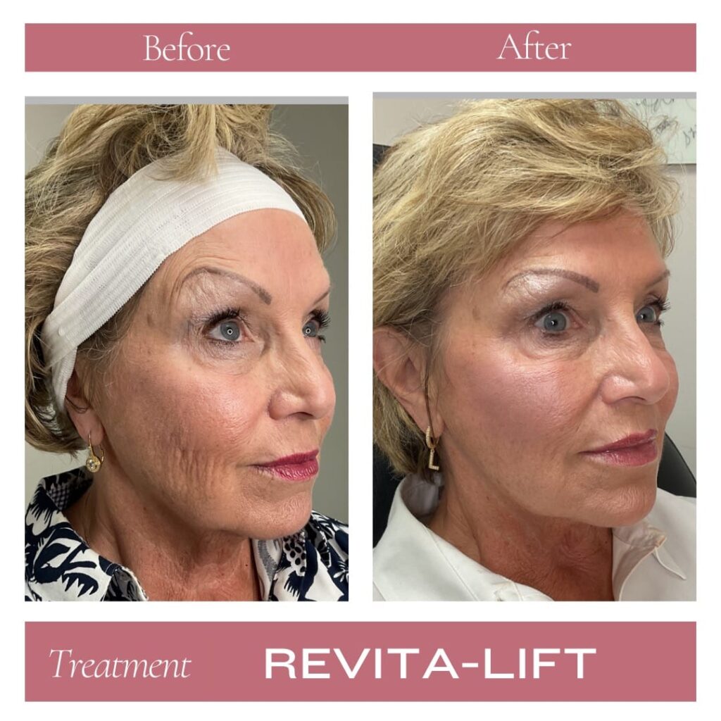 Revitalize Medical Spa Gallery Before After Revitalift Filler(7)